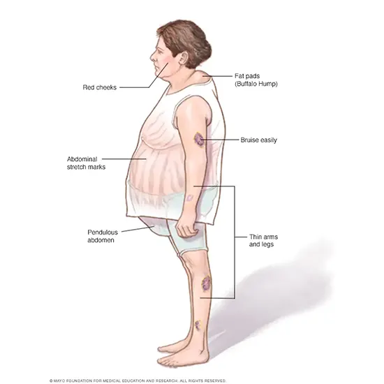 Cushing Syndrome: Signs, Causes, Diagnosis & Treatment